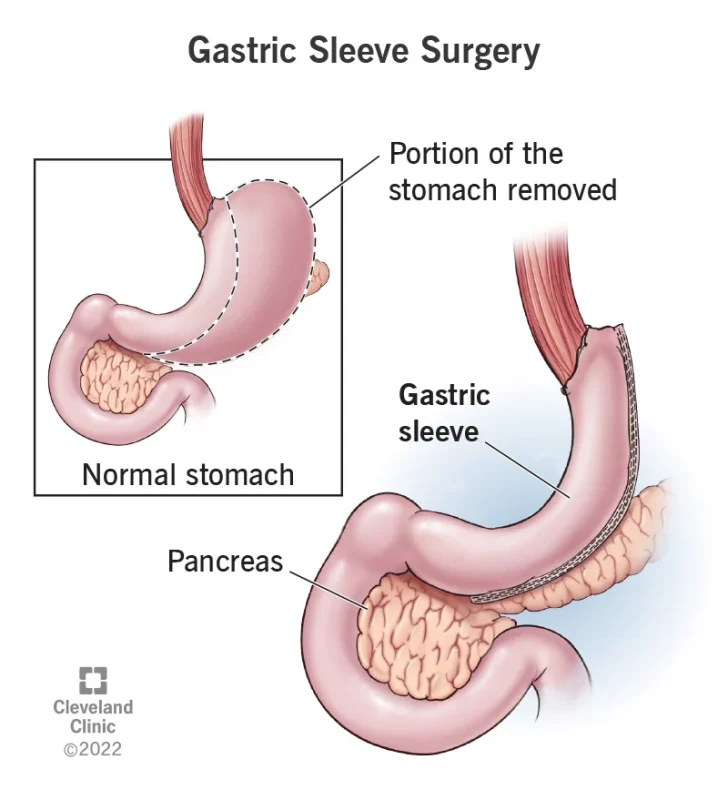 best sleeve gastrectomy surgeon in Iran