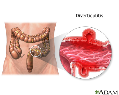 Diverticular surgery in Iran