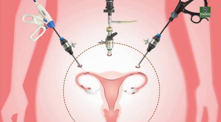Laparoscopic Hysterectomy in Iran