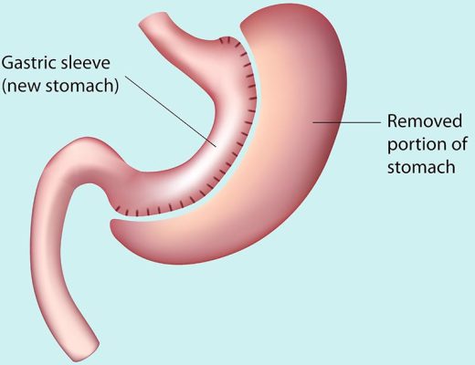 Gastric Sleeve in Iran