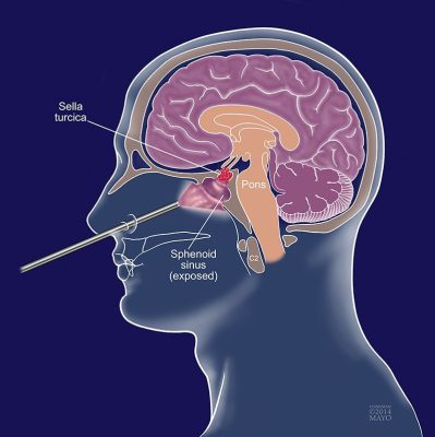 Pituitary gland surgery in Iran